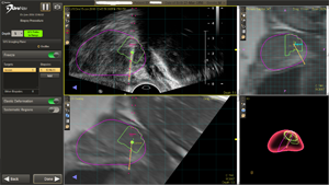 mri fusion Prostate Biopsy mri fusion Prostate Biopsy